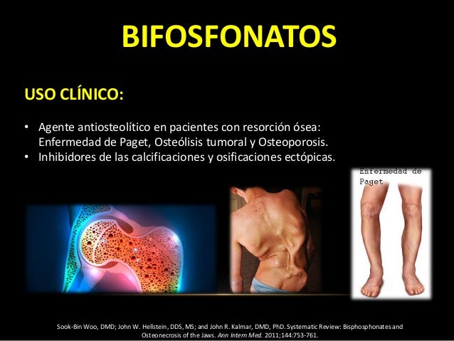 bifosfonatos en odontologia
